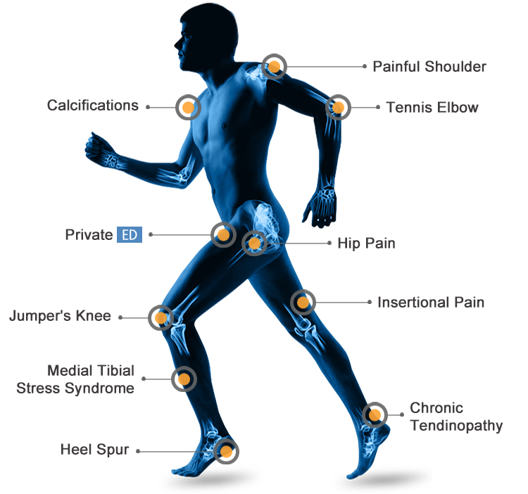 shockwave therapy machine