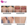 Vagina Hair Removal Machine 808 Diode for Hair Remover Vagina Hair Removal Machine For Sale